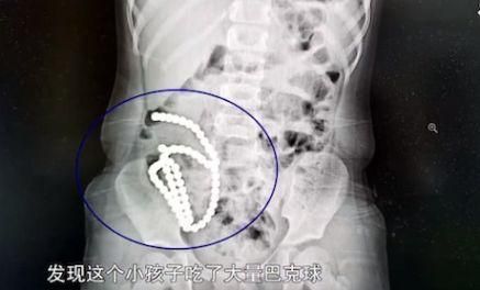 4歲女童「腹痛一個月」就醫驚見「61顆磁力球」　醫：毀了一輩子！