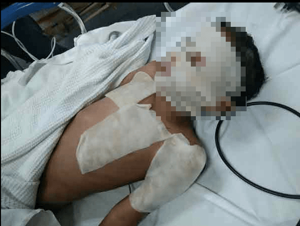 鄰居買小蘇打粉通水管！竟引爆樓下廚房爆炸　9歲男童「毀容恐失明」