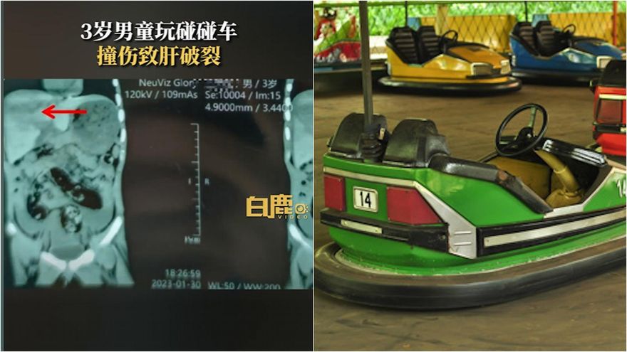 恐怖碰碰車！3歲童玩到撞欄爆肝　狂失血昏迷送醫搶救