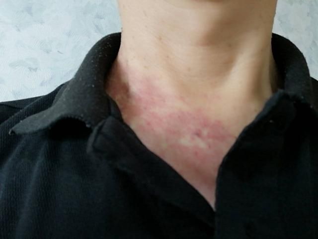 真的要注意！食道癌好發50歲以上男性 出現吞嚥困難往往已是中晚期