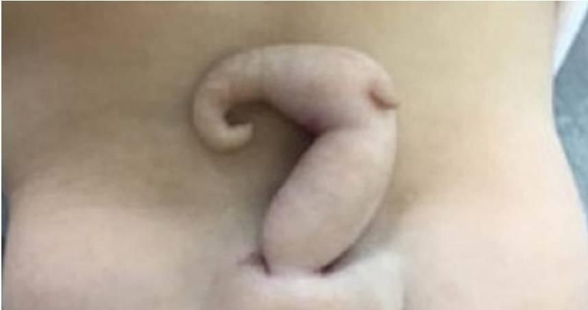 超罕見！巴西女嬰出生帶「6公分尾巴」　全球不到200例！