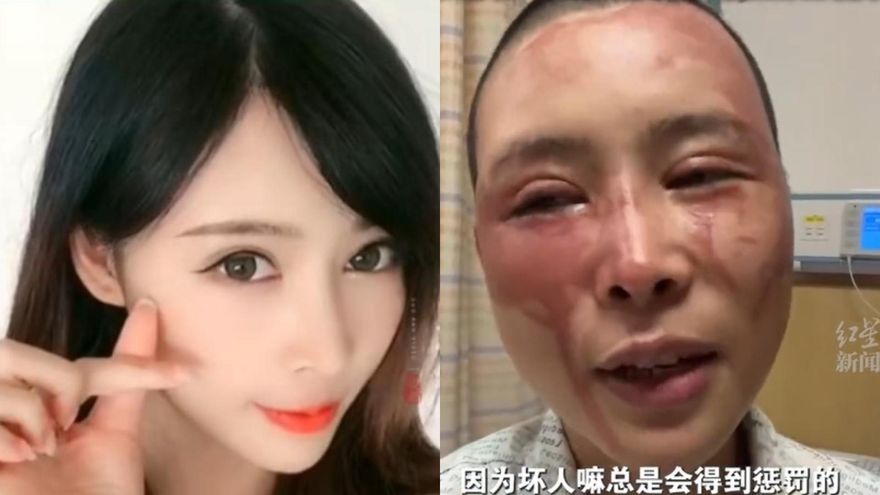 影/不堪家暴訴請離婚…美女人妻遭潑酸毀容　狠夫僅拘10天罰款1770元惹眾怒