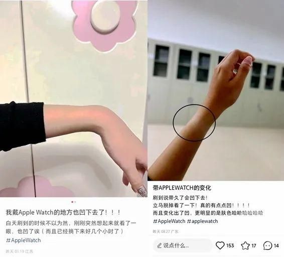 快檢查！戴Apple Watch「手腕凹了」官方回應曝　醫稱出現「這症狀」立刻拿下