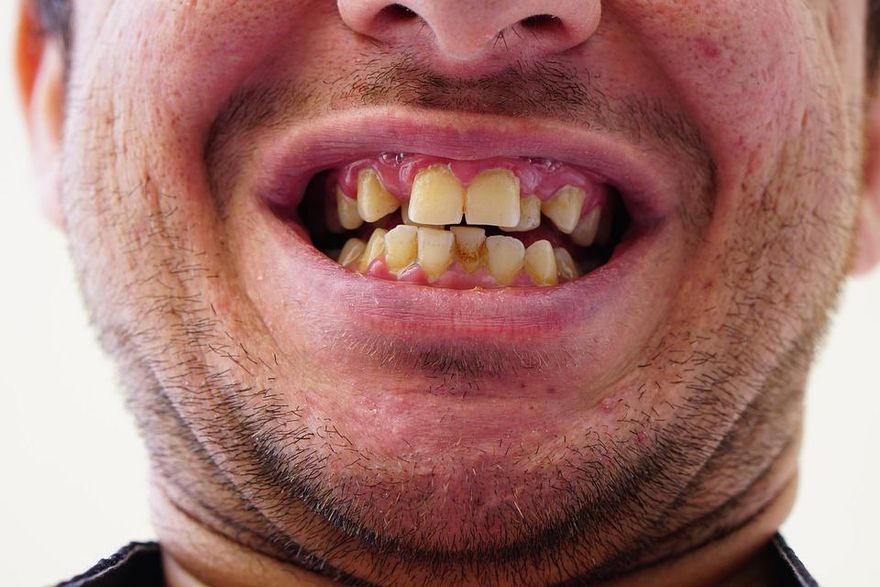 牙周病盛行率逾8成！研究：恐增加心血管疾病風險