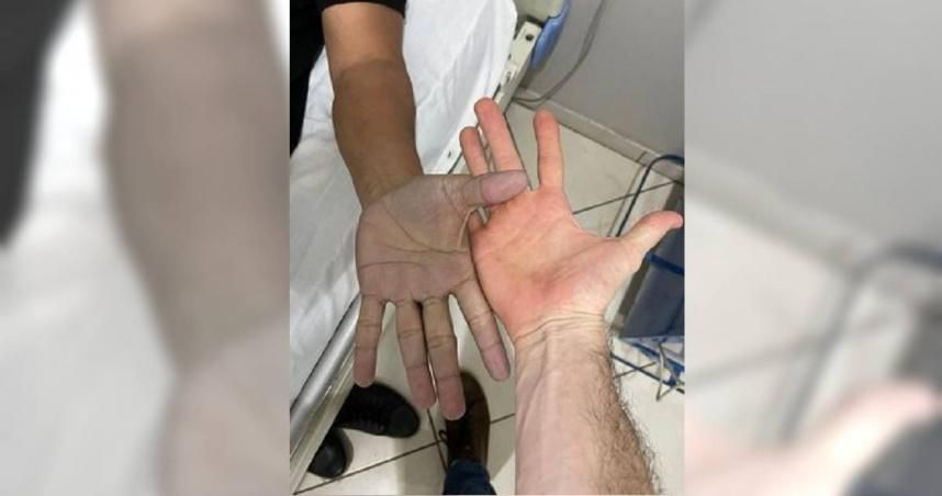 不敢相信！男子雙手突發青緊急就醫　醫詢問後笑翻「你現在就去洗手！」