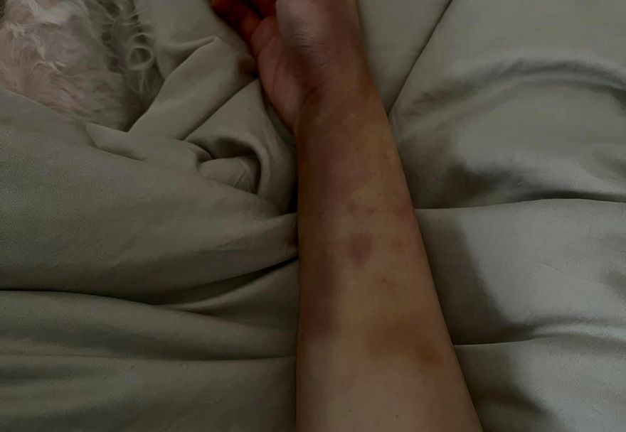 黑一塊青一塊！小謝金燕突曬「恐怖瘀青照」　舒子晨直喊「被往死裡打」