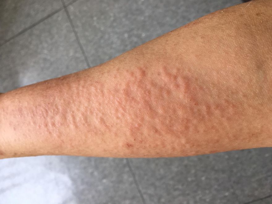 惱人汗皰疹中醫能治嗎？中藥外洗方不藏私大公開