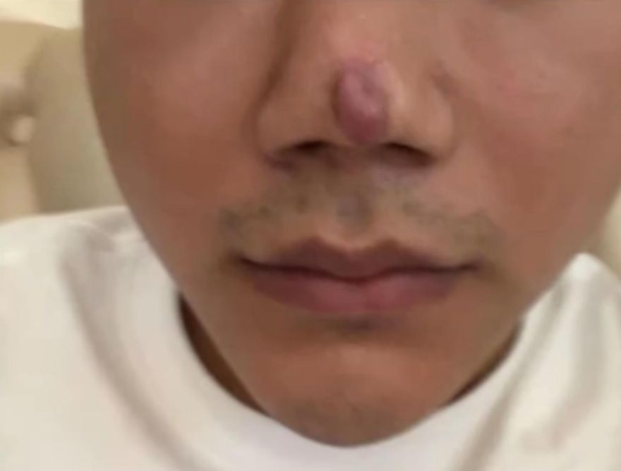 白整了！術後鼻上留疤現「大紅豆」　陸男控：無法再靠顏值「吃飯」