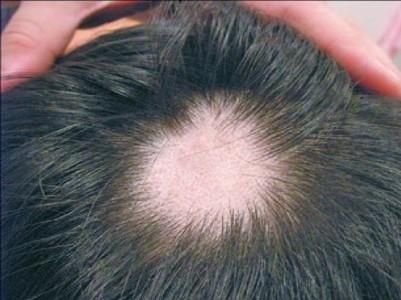 頭皮出油、頭髮變細是禿頭前兆？網議「5大禿頭前兆」一次看