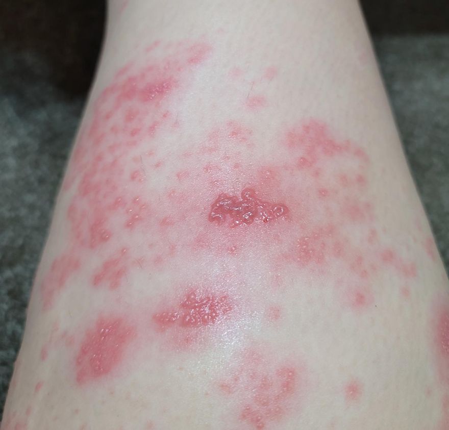 6旬運匠左腹劇痛長紅疹　竟10年舊疾復發　醫警告：生活作息要正常