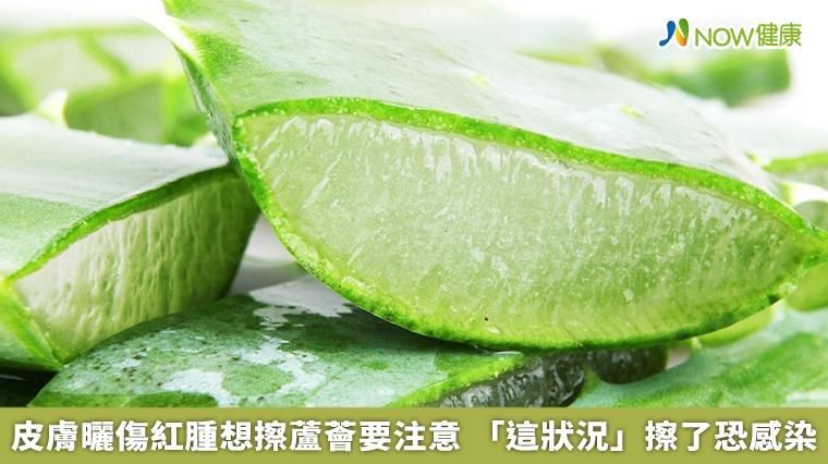 曬傷擦蘆薈真的有效？　醫：2大狀況應立即就醫