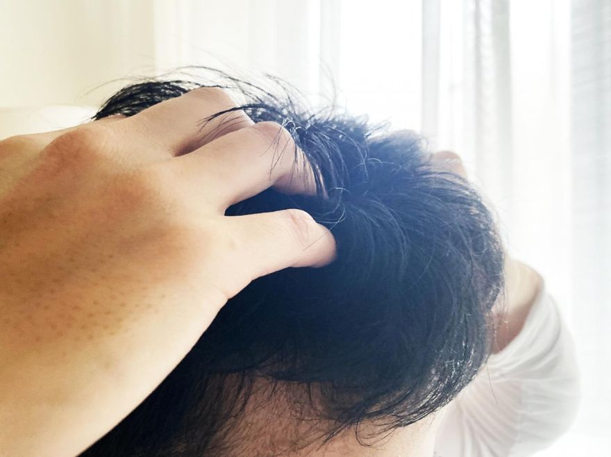 頭皮長痘痘該怎麼辦？6招皮膚攻略　消除頭皮毛囊炎、去痘痘