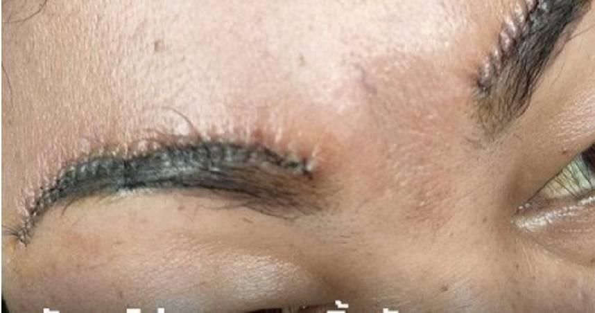 扯！做雙眼皮手術離譜醫「動到眉毛」　她氣瘋「兩邊還不對稱」