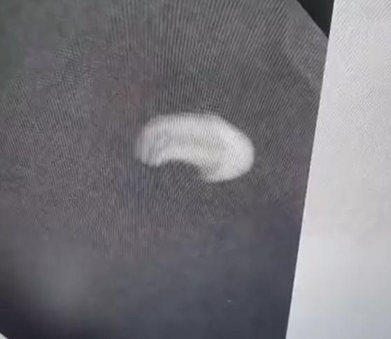 影/太嚇人！老婦摔倒嘴腫一個月　就醫發現「這個」竟嵌入嘴唇