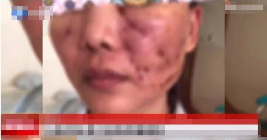 注射1劑「童顏針」滿臉冒膿包！網紅喊煎熬「整整3年不敢外出工作！」