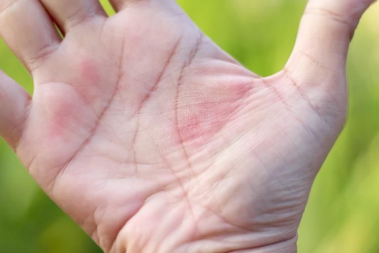 婦筆芯「插手掌45年」沒拔！醫一看傻眼「太瘋狂了不敢相信！」