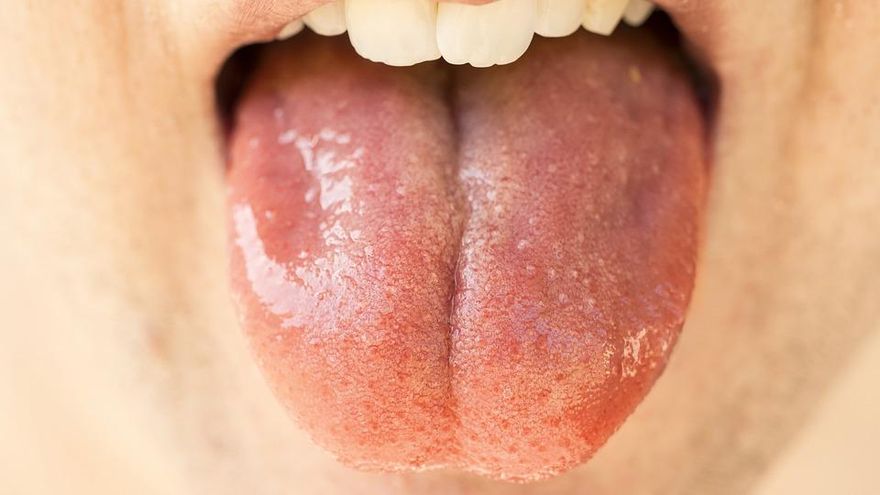 舌頭白白的、不規則形狀？吃酸辣食物有燒灼感　恐是「地圖舌 」惹禍