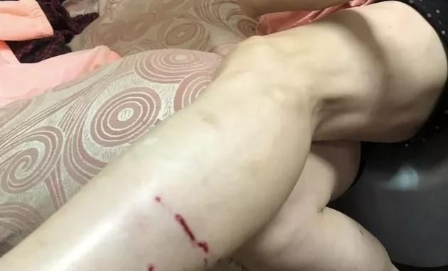 河濱公園野狗攻擊人！新北婦慢跑遭7犬開咬　小腿傷口10公分