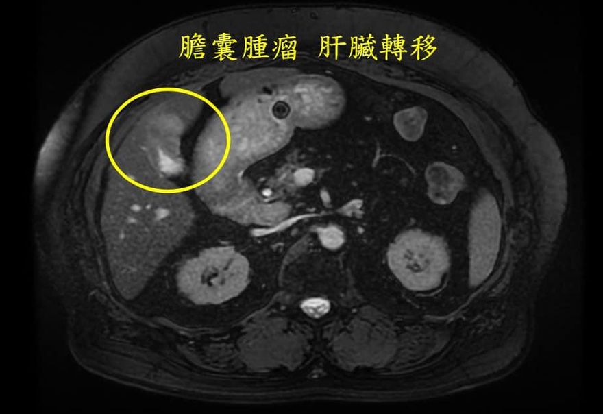 驚！上吐下瀉竟已「罹癌第4期」　醫師揭7引火線6警訊 那些「癌」最易中！