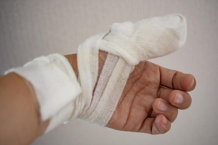 全身64.5%燒傷、經20次的清創　排球健將截肢、忍痛復健燒傷重生之路艱辛