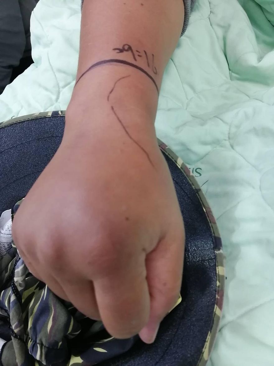 毒蛇出沒！正妹採青梅遭「赤尾青竹絲」咬傷手發紫　醫籲：4件事不要做