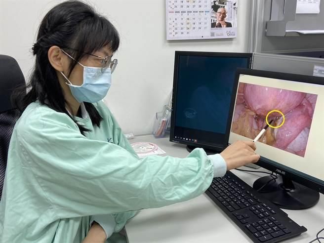 巧克力囊腫可能癌變！「這些人」是高危族群