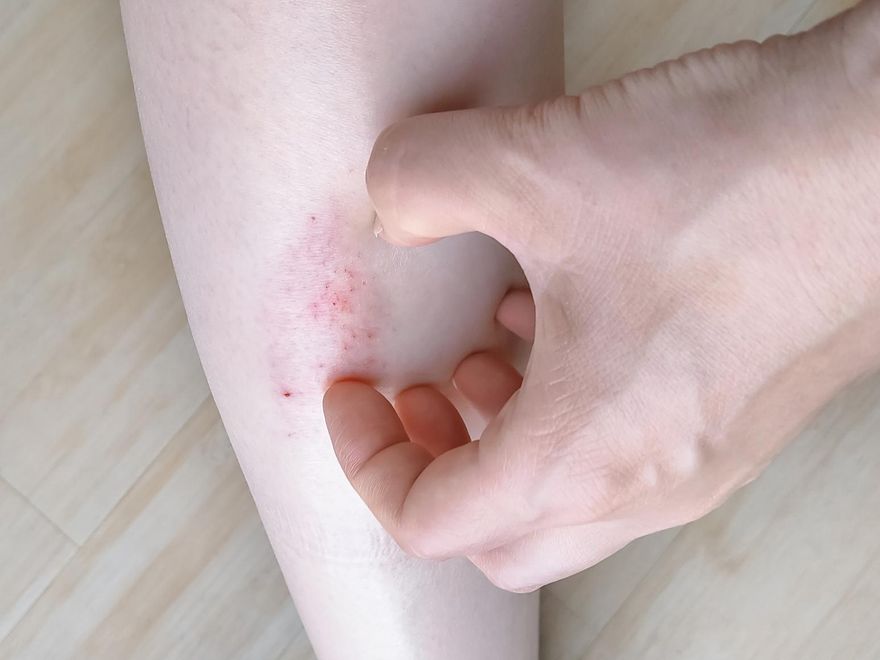 異位性皮膚炎與脾胃功能失調有關！ 中醫授「4藥材」搭配膏藥治療效果更佳