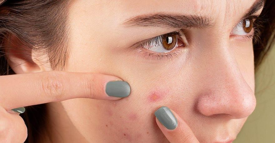 臉上冒痘位置看出「內臟狀態」！醫師提醒「危險三角區」別亂擠