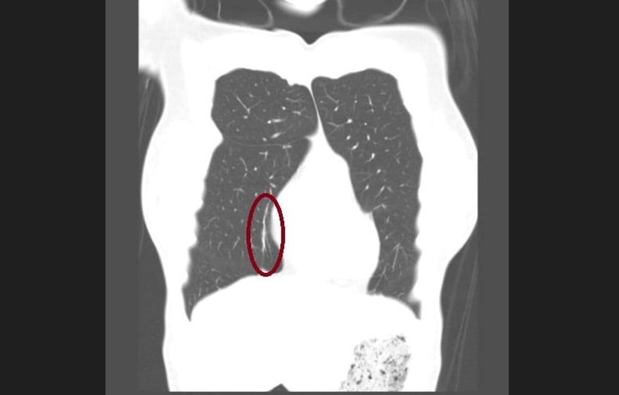 年輕女子吸「爆珠香菸」咳不停　電腦斷層一照…才知「肺爆炸了」