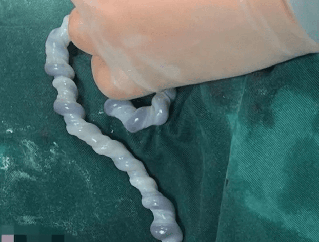 腹內玩頭轉？準媽媽懷孕34週剖腹產女　醫見「臍帶轉54圈成螺旋狀」