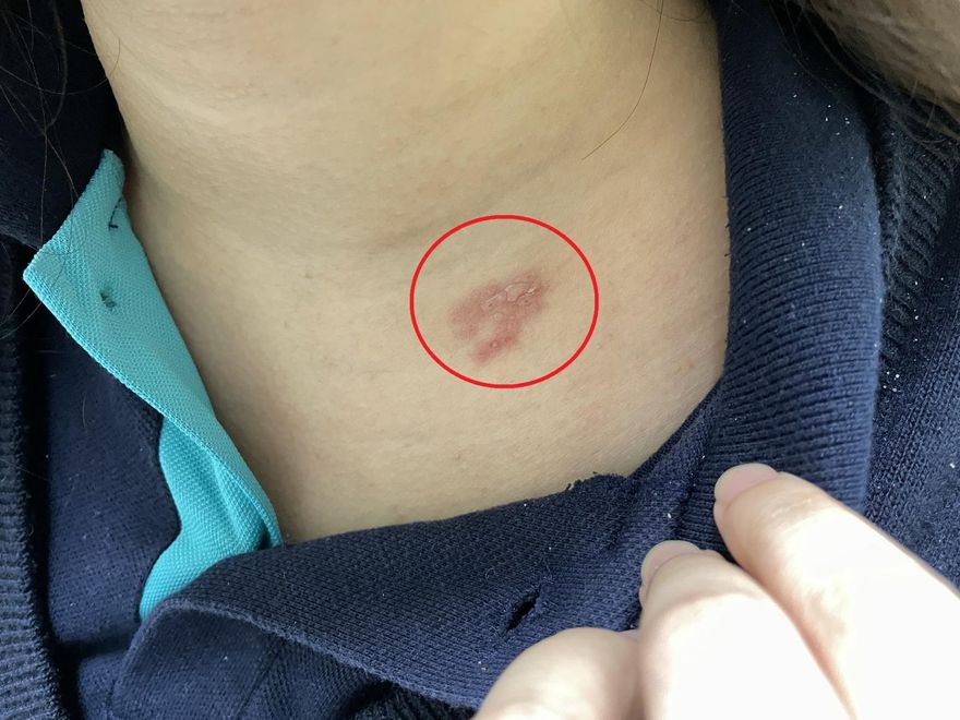 慘上加慘！27歲OL確診長紅疹以為被蚊子叮　醫驚呼：是雙重感染