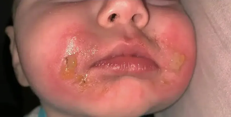 女嬰因啃芹菜　造成「瑪格麗特灼傷」！接觸特定蔬果且受陽光照射小心皮膚炎