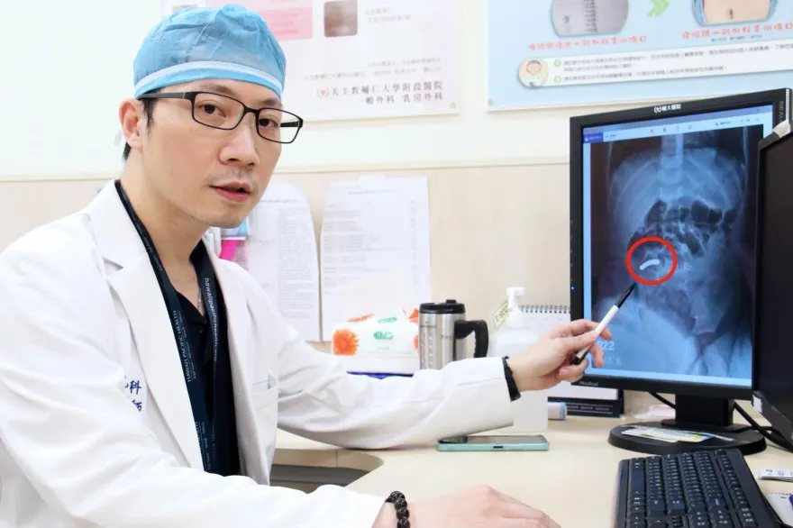 慘！2歲男童誤食「7顆巴克球」　腹痛就醫驚見「腸道穿孔」腸壁缺血壞死
