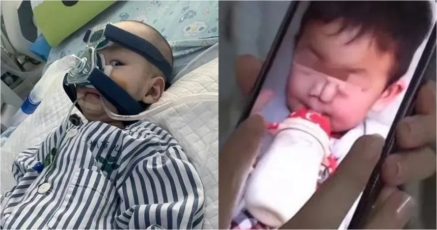 全球僅34例！3歲女童長出罕病「大象鼻」　最嚴重得依賴呼吸器維生