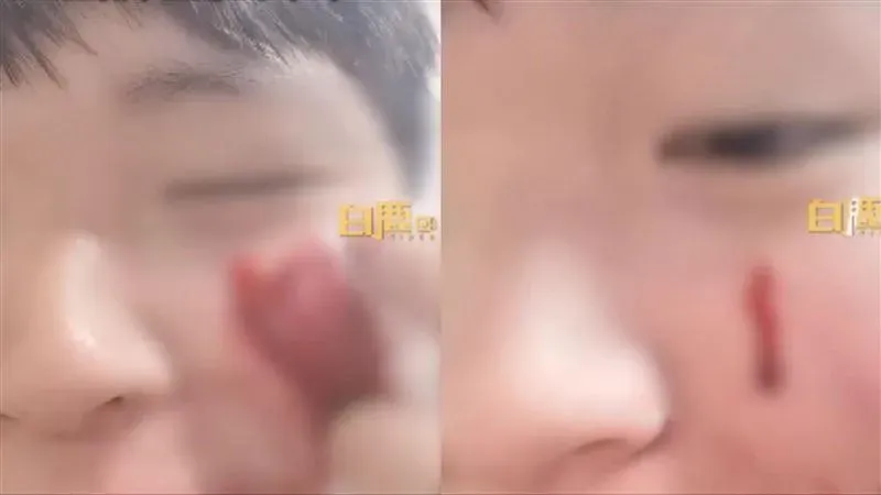 影/勸世片！他隨手摳痘痘竟「噴血1小時」　抽400張衛生紙止血驚喊：再也不敢了