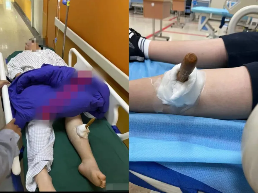 影/光看就痛！小學生遭同學用「整支鐵錐插入」小腿　警方冷回：勞作課玩鬧而已