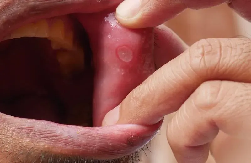 阿伯「口腔潰瘍」插管進加護病房！一查竟是口腔細菌致心臟感染