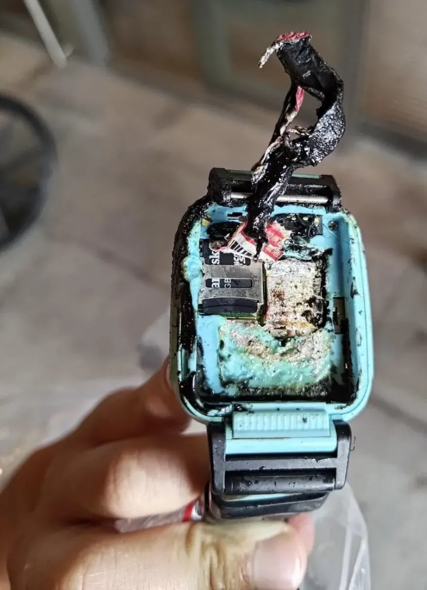 智慧手錶突爆炸！10歲童手臂遭炸傷　二度燒燙傷恐植皮