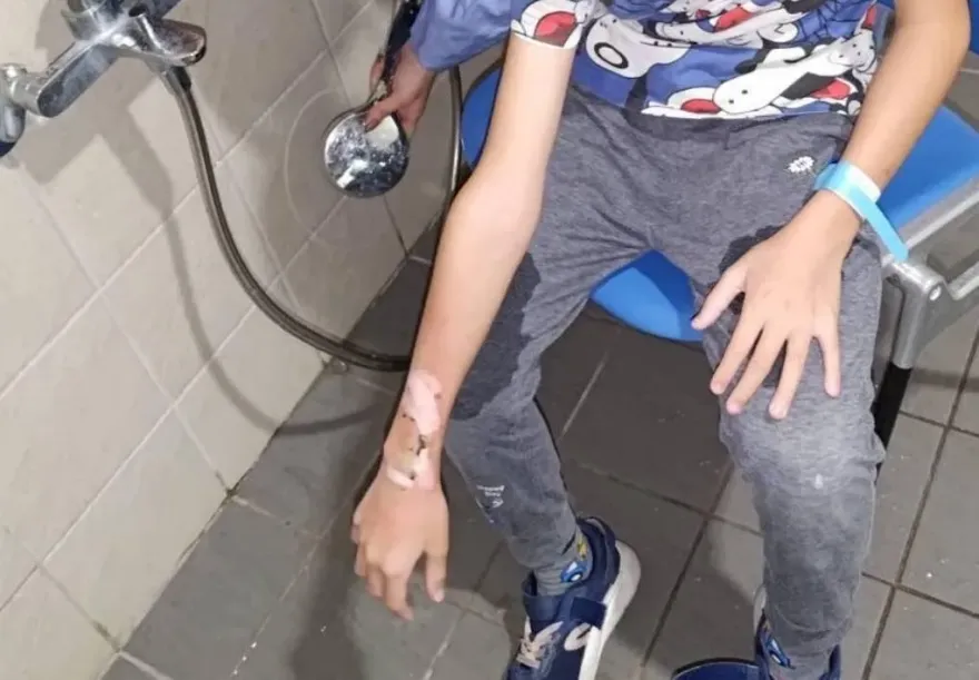 智慧手錶在手腕上爆炸！10歲童二度燙傷「恐植皮」　業者：第一代需更換電池
