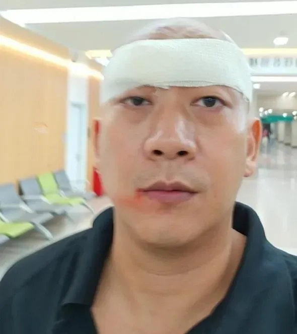 拍張藝謀新戲出意外！李嘉遭燈擊中血流如注「險成獨眼龍」