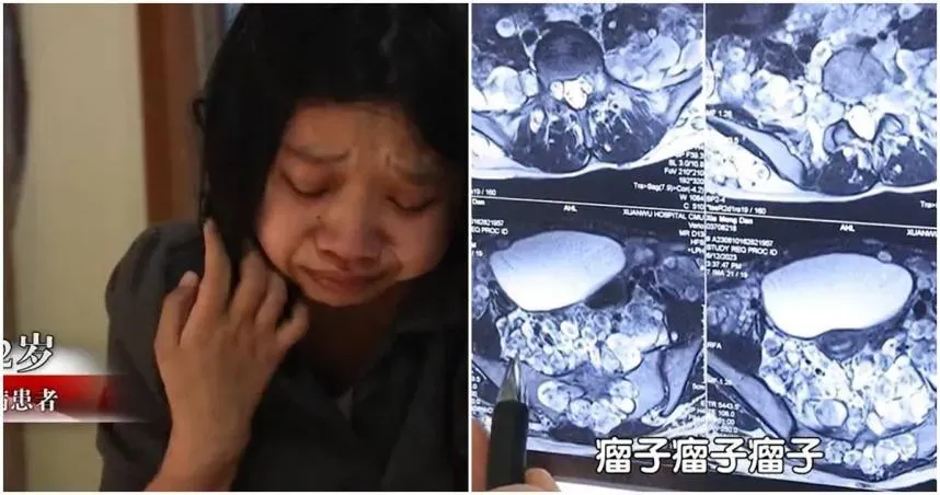 22歲體內「上千顆腫瘤」連脖子都難動！是罕病「多發性神經纖維瘤症」