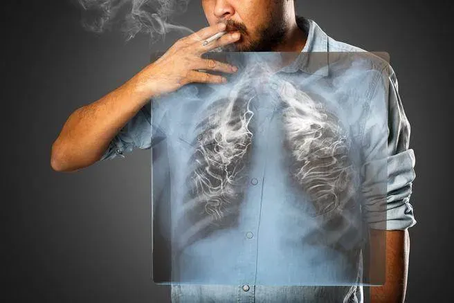 58歲老菸槍一動就累！就醫驚見患「菜瓜布肺」　醫警「死亡率超過50％」