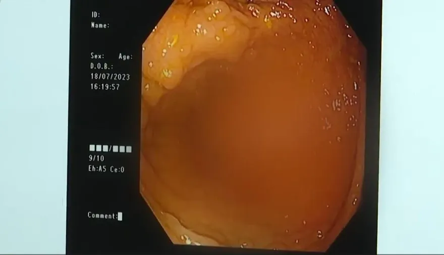 影/腸道如「溶洞」！長滿200多顆息肉　醫生為他「狂摘」近3小時