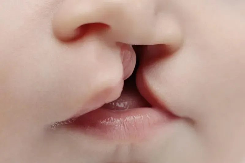每600個新生兒就有1個唇顎裂！ 先天顱顏缺陷的孩子該被生下嗎？