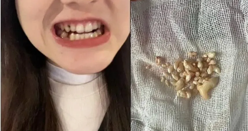 嫩妹「一次拔57顆牙」連牙醫都興奮！每顆大大小小神似爆米香