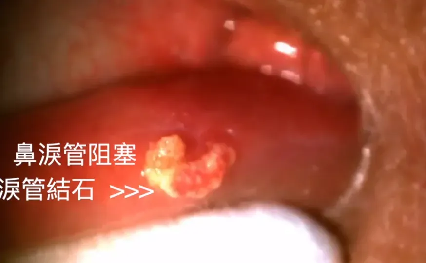 淚眼汪汪不是愛哭！眼有分泌物、紅紅的恐是「淚管結石」