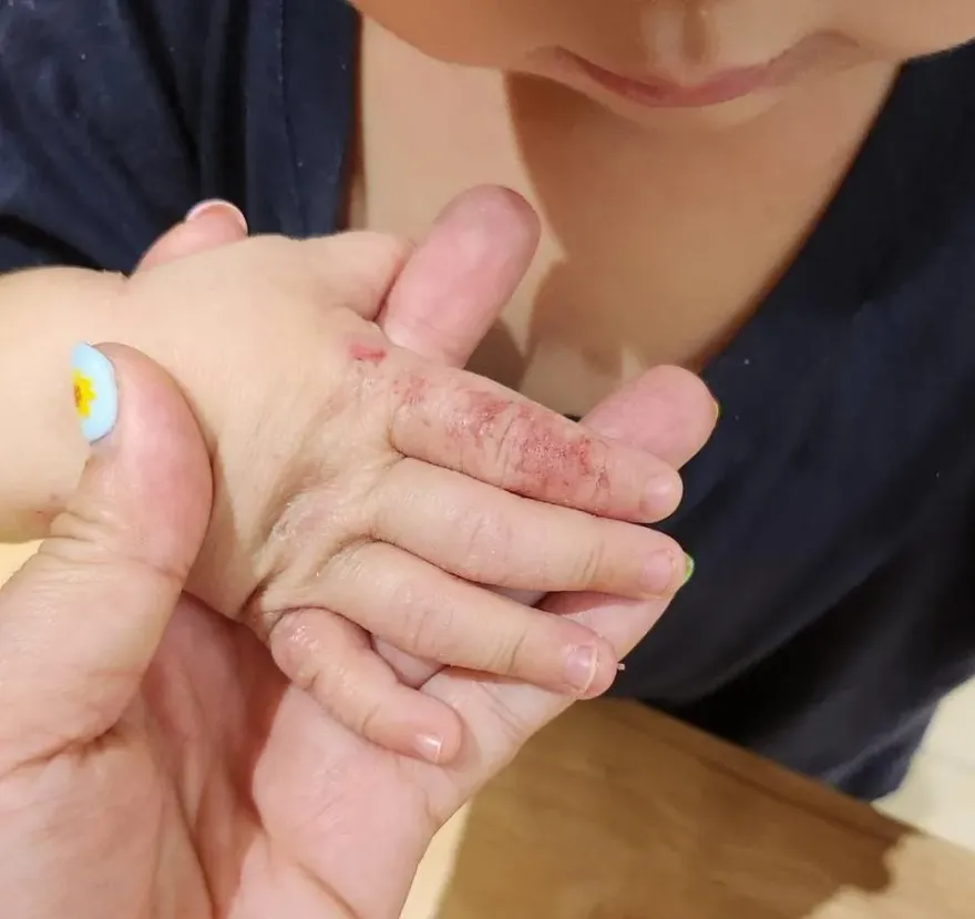 別再抓呀抓呀抓！1歲童「異膚」發炎流膿細菌感染　兒科醫師授解方