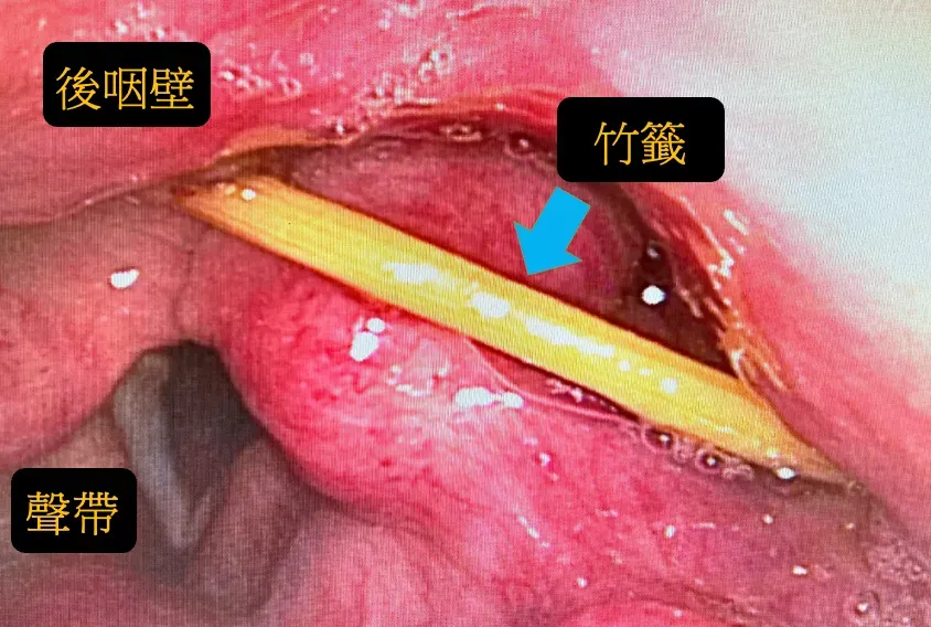 吃肉串吃太急連竹籤都吞了！醫驚呆　嚴重會大出血導致窒息