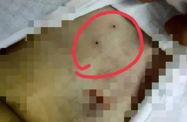 4歲女童命喪手術台！做骨髓穿刺卻碰上醫療疏失　醫生失手「連刺兩針進心臟」