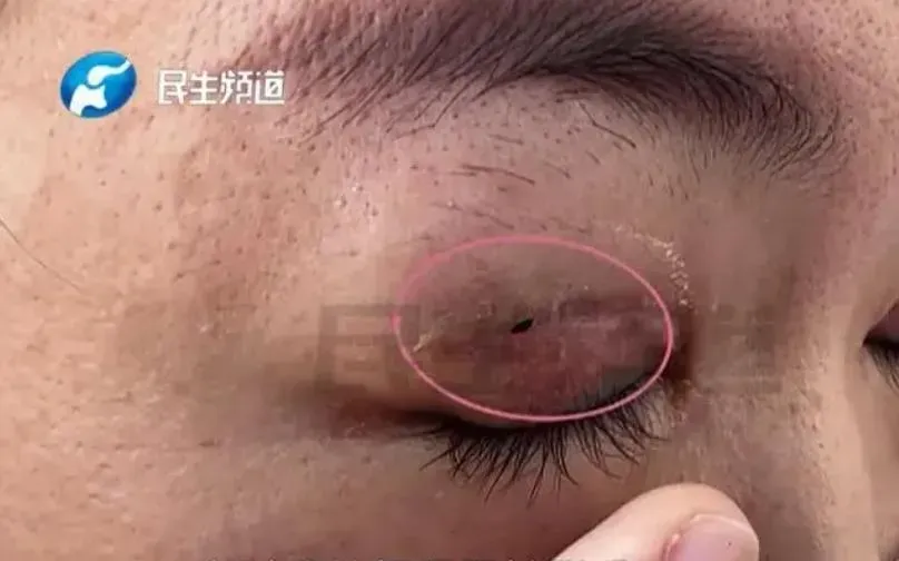 影/花1.3萬修復雙眼皮…拆線後多個洞　她怒控「閉上眼還能看見外面」